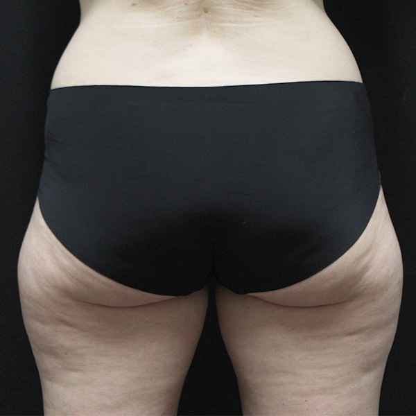 Coolsculpting Before and After | Before Picture