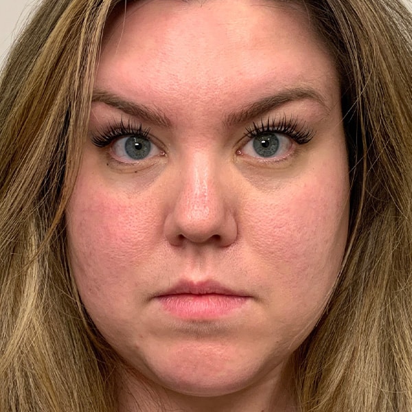 Botox® & Xeomin® 14 After
