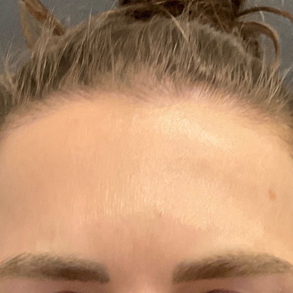 Botox® & Xeomin® 8 After