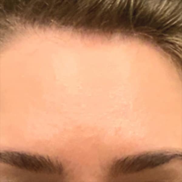 Botox® & Xeomin® 20 After