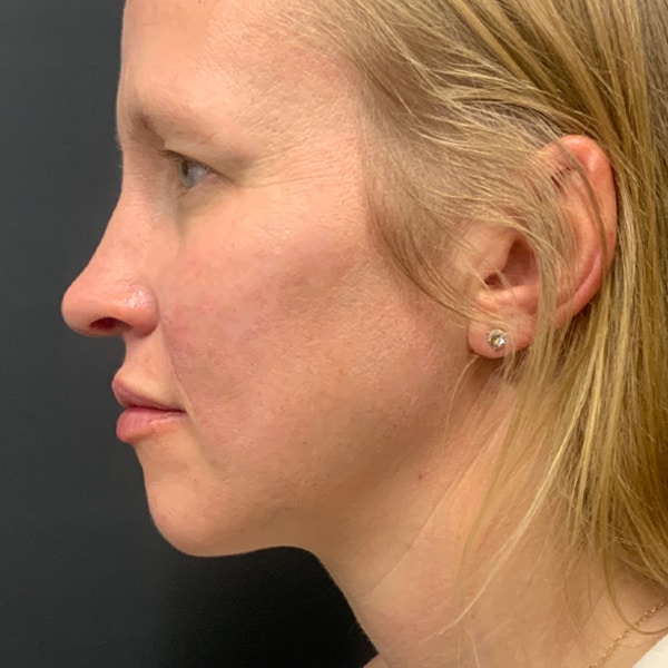 Dermal Fillers 18 After full face filler