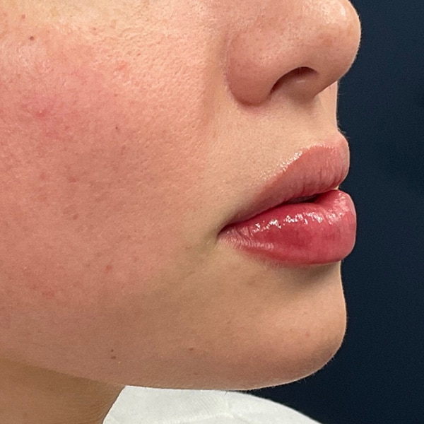 Dermal Fillers 14 After lip filler