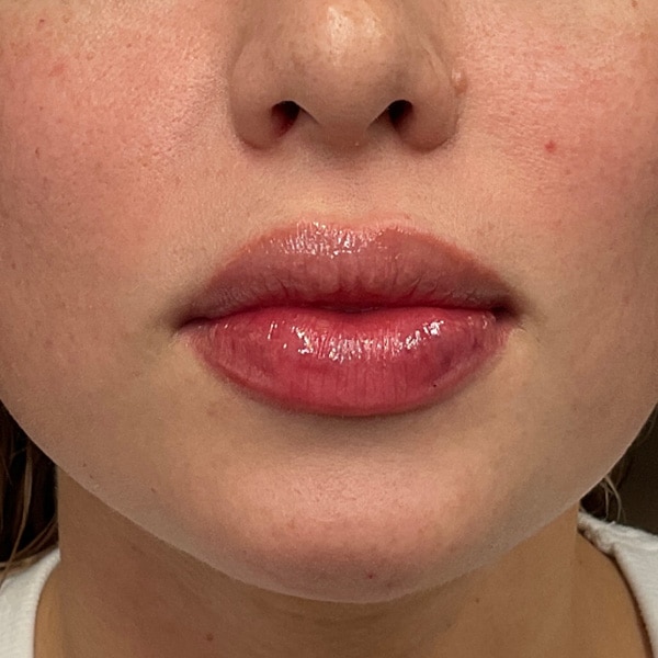 After lip filler