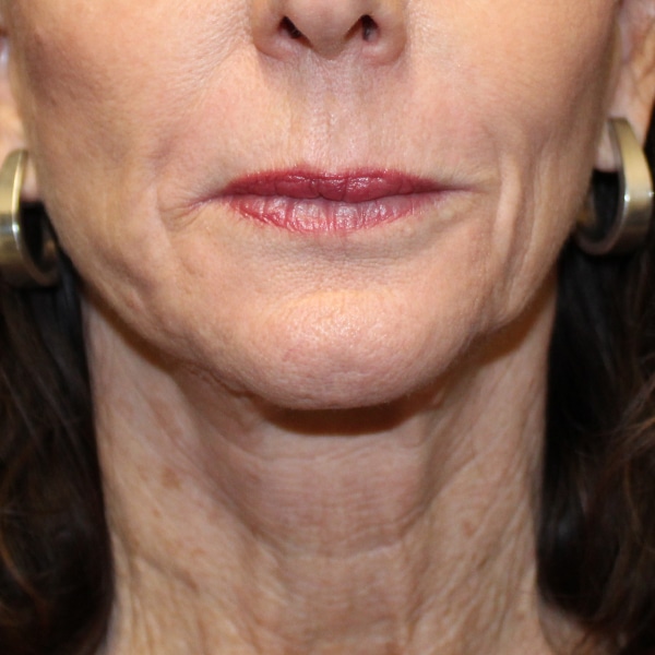 Laser Resurfacing 20 After