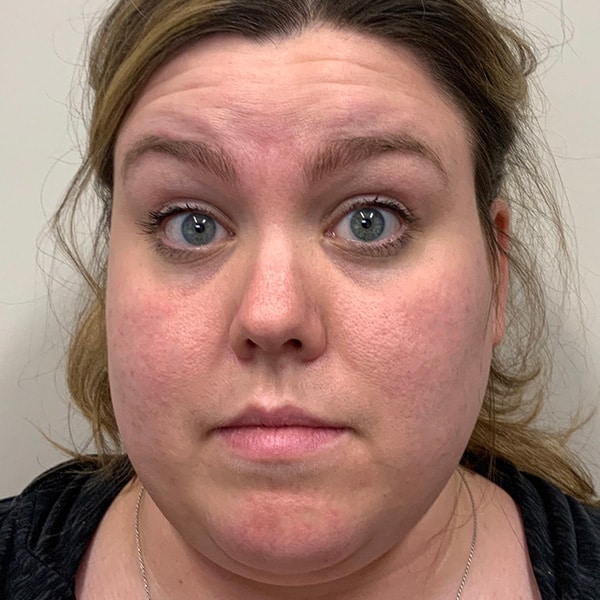 Botox® & Xeomin® 13 Before