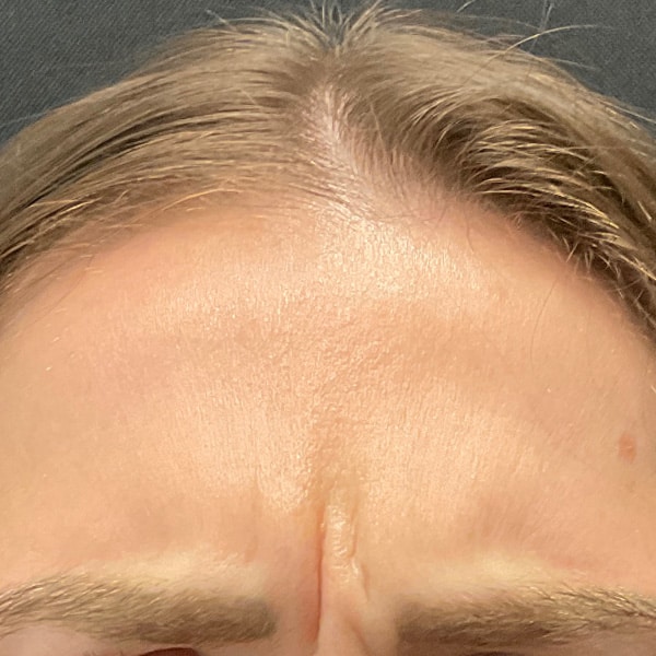 Botox® & Xeomin® 7 Before