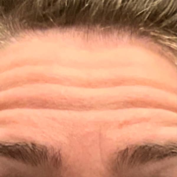 Botox® & Xeomin® 19 Before
