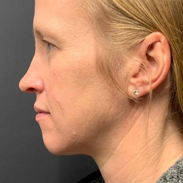 Dermal Fillers 17 Before full face filler
