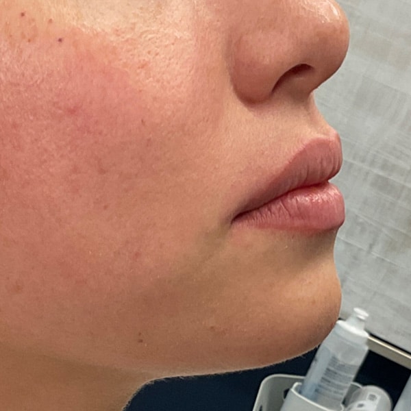 Dermal Fillers 13 Before lip filler