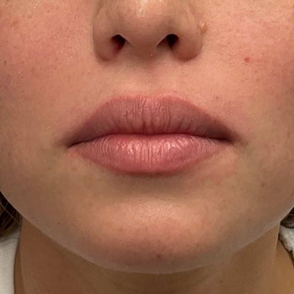 Before lip filler