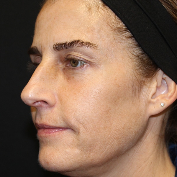 Sculptra® Aesthetic Gallery 6 After