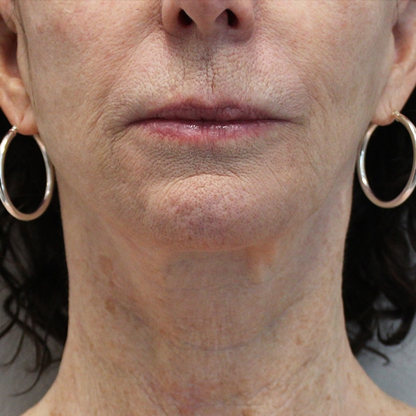 Laser Resurfacing 19 Before