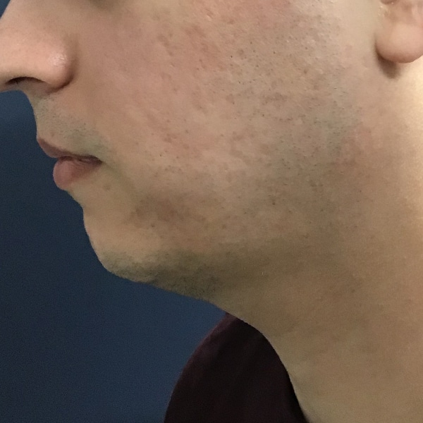 Rejuvapen™ NXT Microneedling 6 After