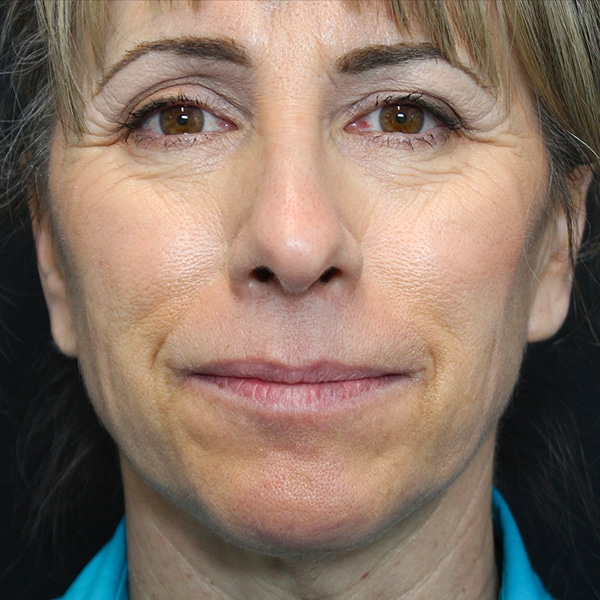 Woman with wrinkles around her eyes