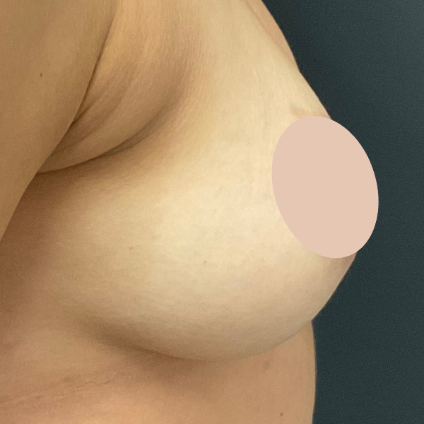 After PRP + PDO Breast Lift