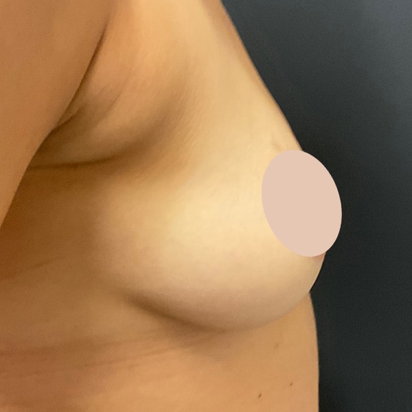 Before PRP + PDO Breast Lift