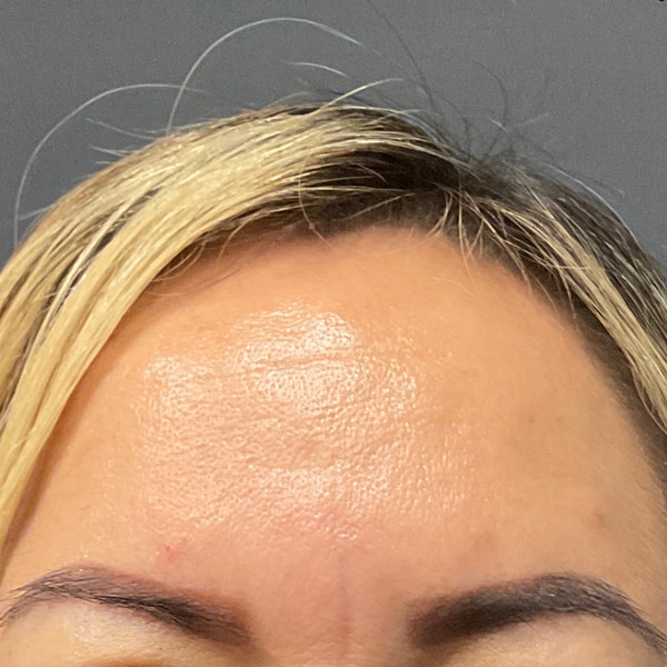 Botox® & Xeomin® 6 After