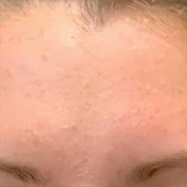 Botox® & Xeomin® 22 After
