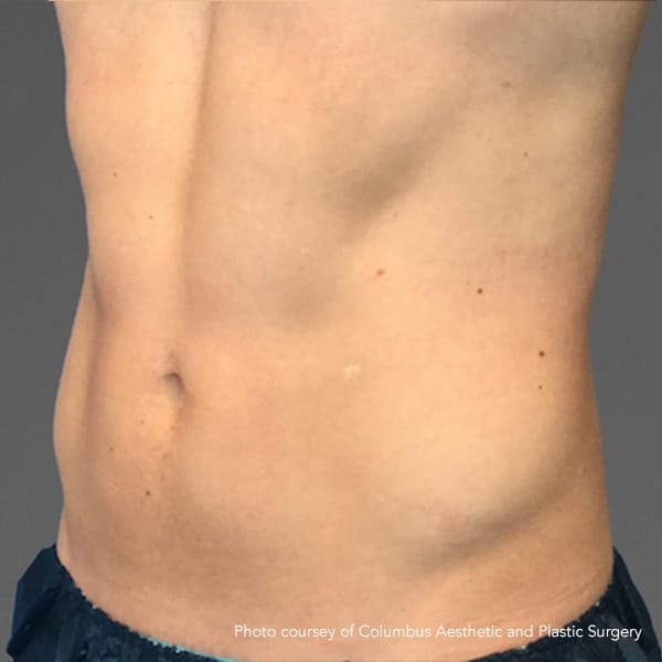 Tone male abs after 4 CoolTone Treatments