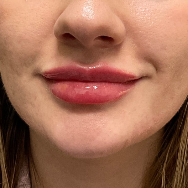 After lip filler