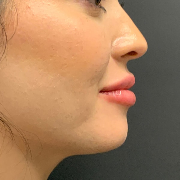 After lip filler