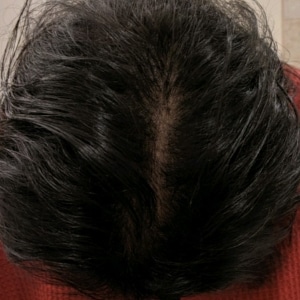 Restored, thicker, fuller hair on top of woman's head after PRP Hair restoration treatment.