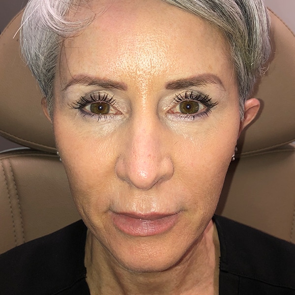 Sculptra® Aesthetic Gallery 8 After