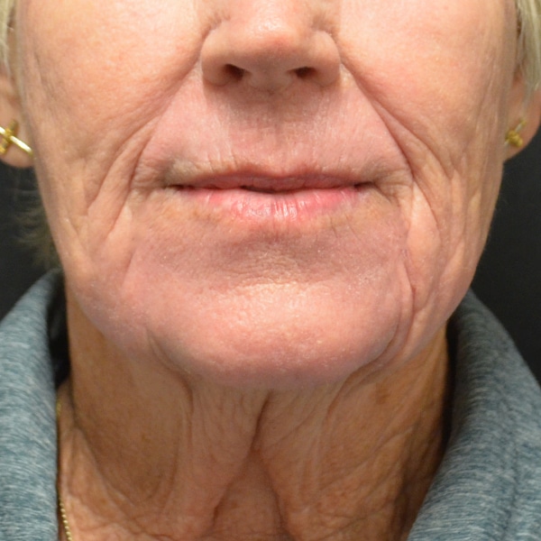 Laser Resurfacing 18 After