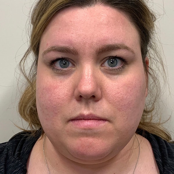 Botox® & Xeomin® 11 Before