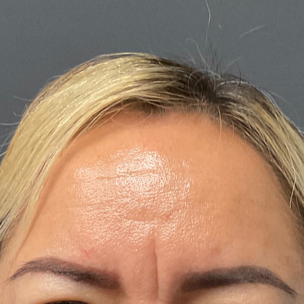 Botox® & Xeomin® 5 Before