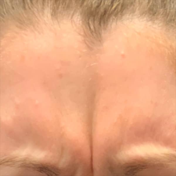 Botox® & Xeomin® 21 Before
