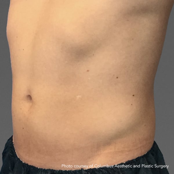 Man's stomach before CoolTone 4 treatments