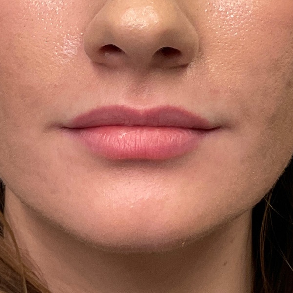 Dermal Fillers 9 Before lip filler
