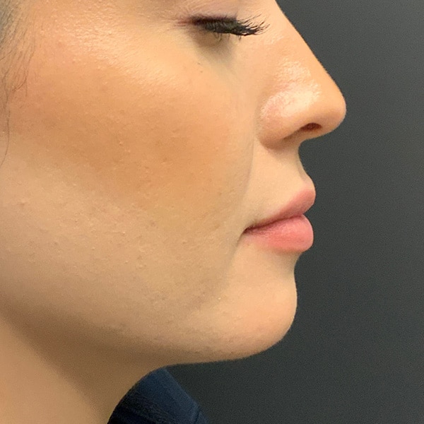 Dermal Fillers 7 Before lip filler