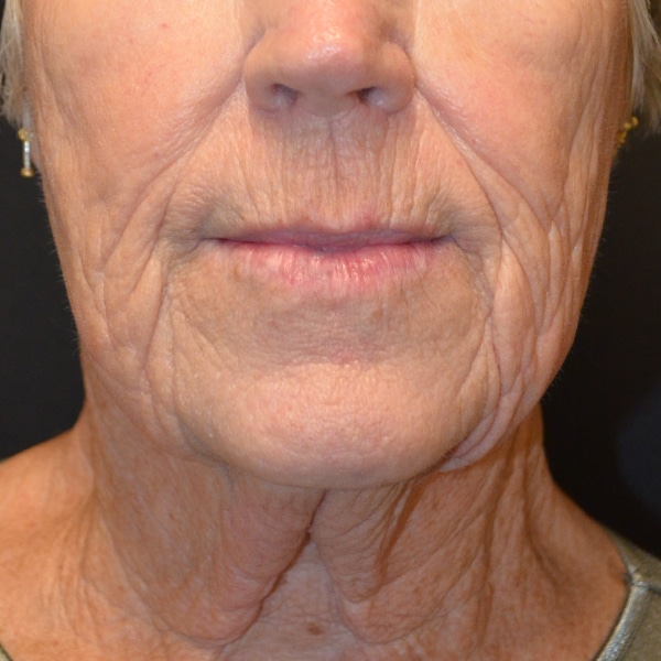 Laser Resurfacing 17 Before
