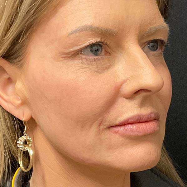 Dermal Fillers 34 After