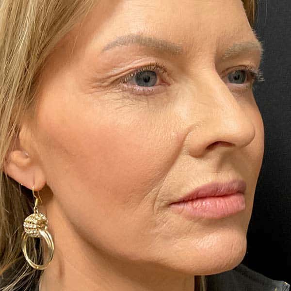 Dermal Fillers 33 Before