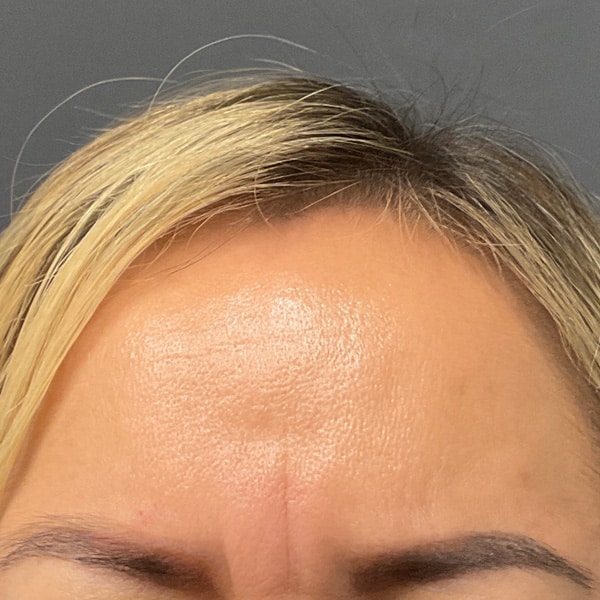 Botox® & Xeomin® 4 After