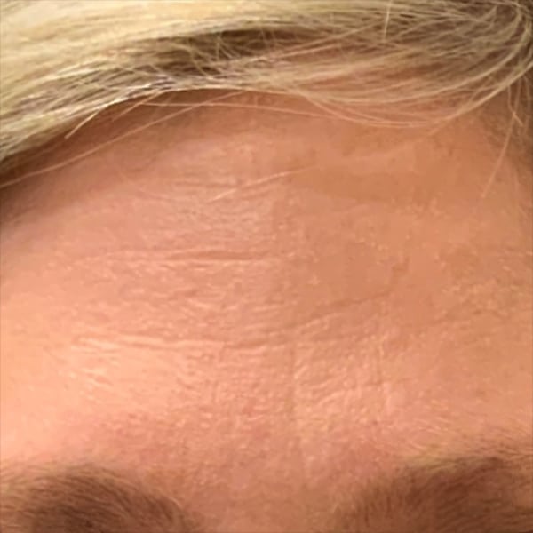 Botox® & Xeomin® 24 After