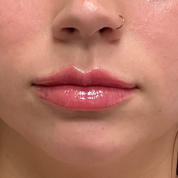 After lip filler