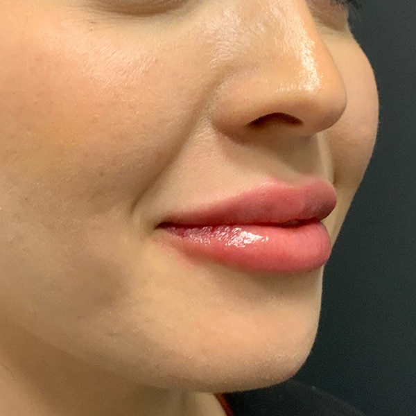 After lip filler