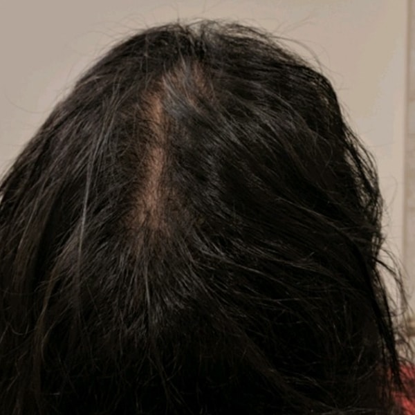 PRP for Hair Loss Before and After | After Picture
