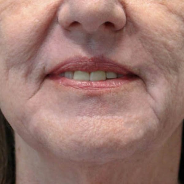 Laser Resurfacing 16 After