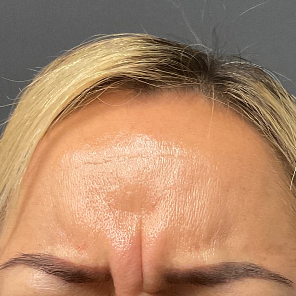 Botox® & Xeomin® 3 Before