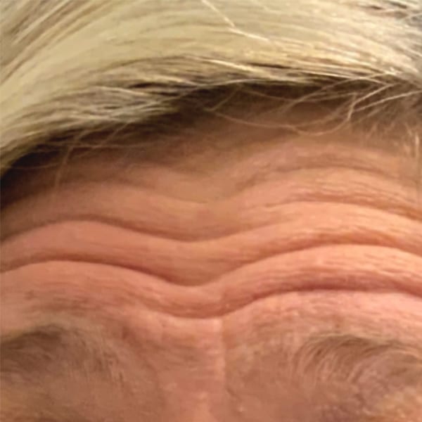 Botox® & Xeomin® 23 Before