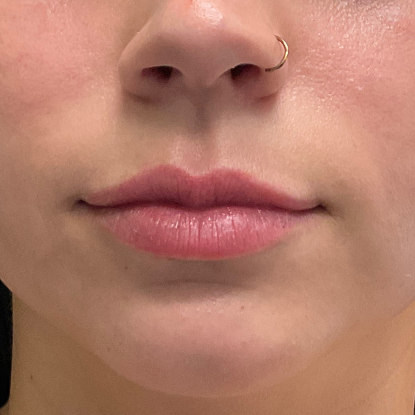 Before lip filler