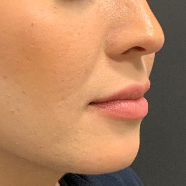Dermal Fillers 3 Before lip filler
