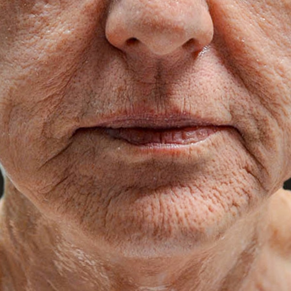 Laser Resurfacing 15 Before