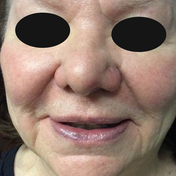 BBL® HERO™ 12 IPL Treatment After