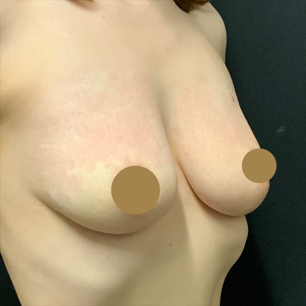 vampire breast lift after photo